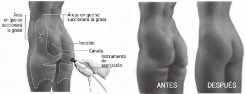 La lipoescultura es el proceder quirúrgico que conjuga la liposucción y la lipoinyección. En él se extrae grasa del abdomen para su posterior reinserción en la región glútea y las áreas adyacentes.