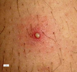 La foliculitis es una de las enfermedades que más afecta a adolescentes y jóvenes que practican el rasurado.