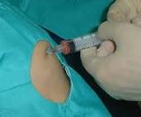 Beneficiados pacientes en Camagüey con medicina regenerativa