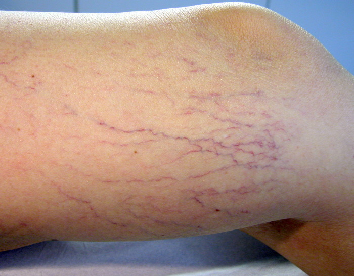 Efectividad de tratamiento contra las várices en Camagüey