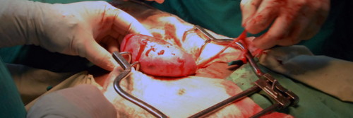En Camagüey, primer trasplante de riñón en edad pediátrica