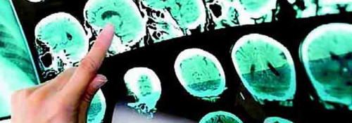 Intercambiarán Cuba y EE.UU. sobre Esclerosis Múltiple