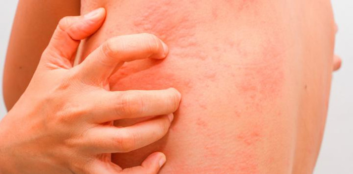 Half of Cuban youngsters suffer from allergies