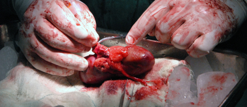 En Camagüey: Primer trasplante renal de donante vivo