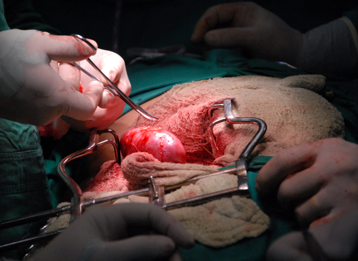 The first renal transplant of living donor In Camagüey