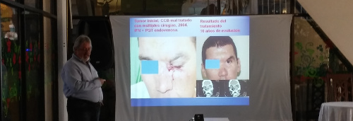 Excellent Results of Drug Developed in Cuba Against Skin Cancer were presented in Workshop