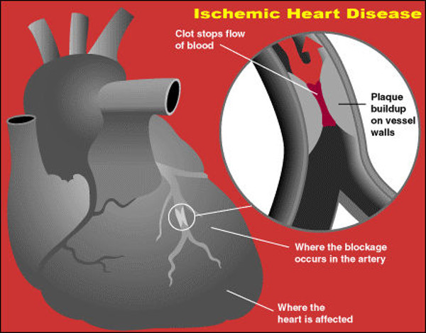 Ischemic heart disease increases in Cuban women
