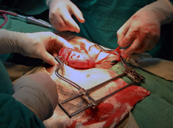 Foto: Otilio Rivero Delgado/ Adelante/ Archivo Trasplantes, una donación de vida (+Audio)