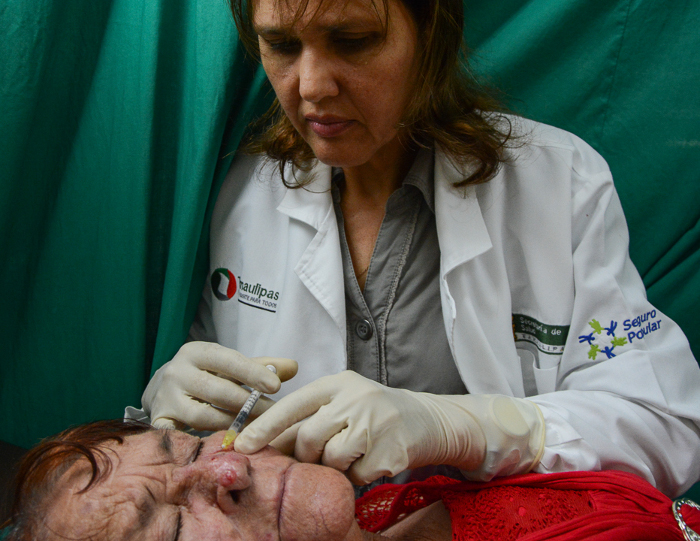 La Dra. Yoddali aplica el HeberFERON intralesión a Graciela. Se observa en el lado derecho de la nariz una pequeña mutilación. Fotos: Leandro Pérez Pérez/Adelante Efectividad del HeberFERON ante el cáncer de piel basocelular