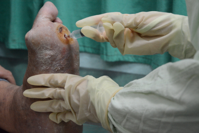 Doce meses más con el Heberprot-P 