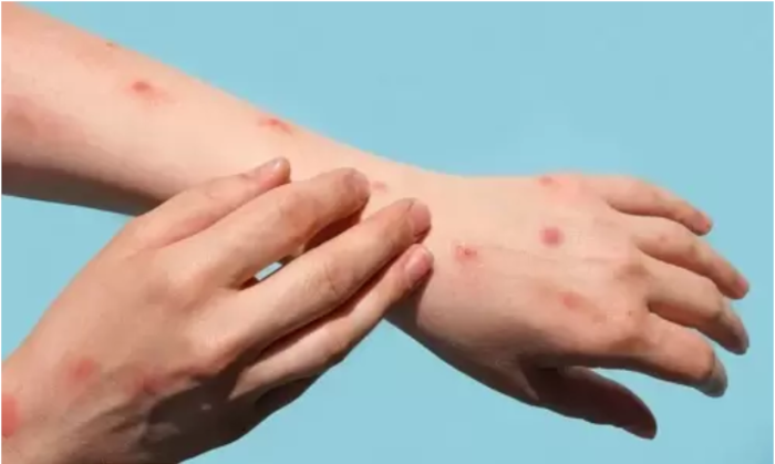 Foto: Tomada de dominiomedios.com Viruela del mono, emergencia nacional en EEUU